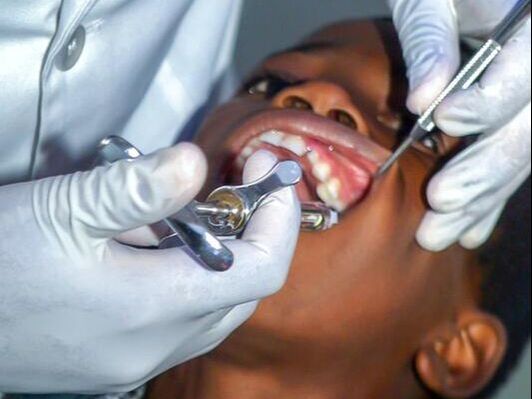 Tooth Extraction/ Removal on Child