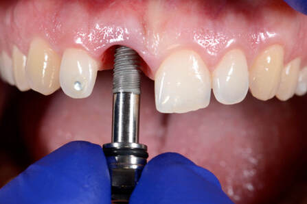 dental implant close-up