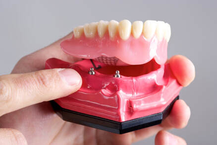 Mini Dental Implants Model